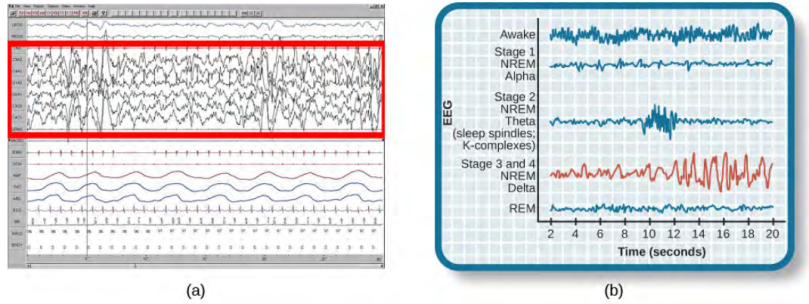Delta waves, which are low frequency and high amplitude, characterize slow-wave stage 3 and stage 4 sleep. There is an image of a highlighted portion of EEG, characterized by delta waves, on the left, marked A, and on the right, marked B, is the same chart of brain activity during the various stages of sleep found above, with the Stage 3 and 4 wave highlighted in red.
