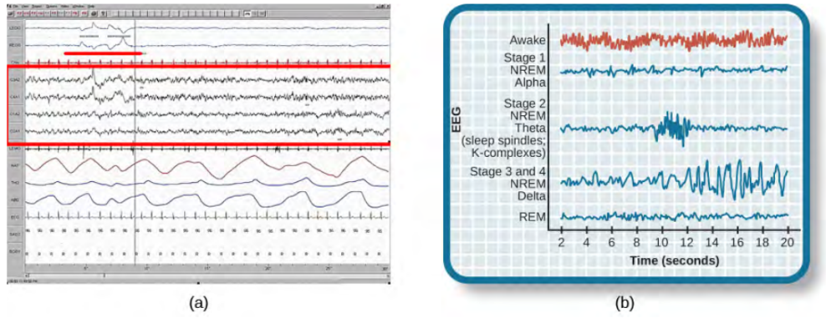 A period of rapid eye movement is marked by a short red line segment in a highlighted portion of an EEG, found on the left of the image, and marked A. The brain waves associated with REM sleep, outlined in the red box in A look very similar to those seen during wakefulness in the chart of brain activity during the various stages of sleep on the right, marked A, in the Awake stage wave, highlighted in red.