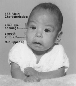 This is a black and white image of a child with Fetal Alcohol Syndrome. The child is wearing a short-sleeved, white top while lying on its stomach on the carpet. There is a dotted line pointing to the baby’s right eye that says small eye openings. There is another dotted line pointing just below the baby’s right nostril that says smooth philtrum. There is another dotted line pointing towards the baby’s upper lip that says thin upper lip. The top of the image says FAS Facial Characteristics.