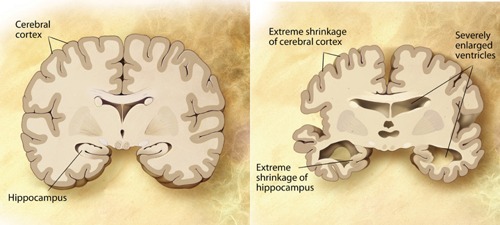 This image shows two cross-sections of the brain. On the left-hand side there is an image of a healthy brain, showing a normal sized cerebral cortex and hippocampus. The image on the right shows a brain with advanced Alzheimer’s disease. This image shows extreme shrinkage of the cerebral cortex, severely enlarged ventricles, and extreme shrinkage of the hippocampus.
