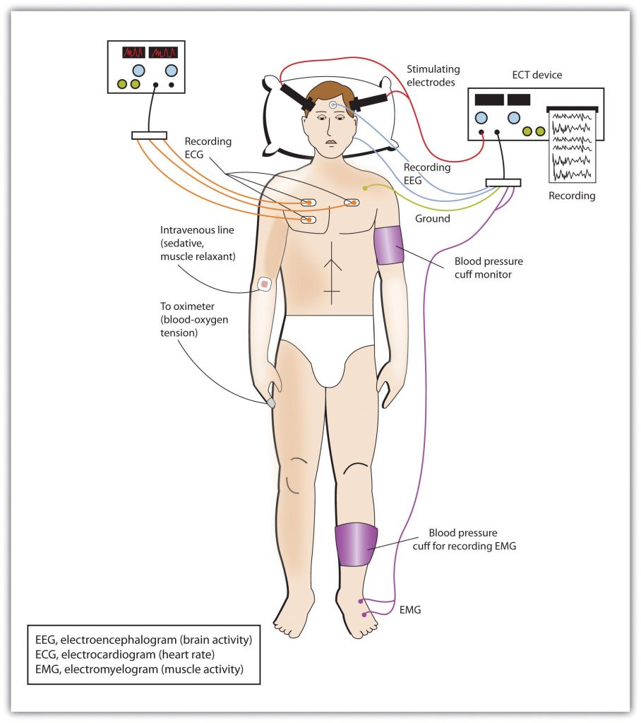 This image shows a drawing of an adult male, lying down in only his underwear. He has a purple blood pressure cuff around his left bicep and around his left calf muscle. He has several stimulating electrodes places on his head which are also connected to the ECT device. He is connected to an ECG recording device by several wires connected to his chest and hear. There is a white and orange circle on the front of his right elbow indicating where the intravenous line would be to provide him with a sedative or muscle relaxant.