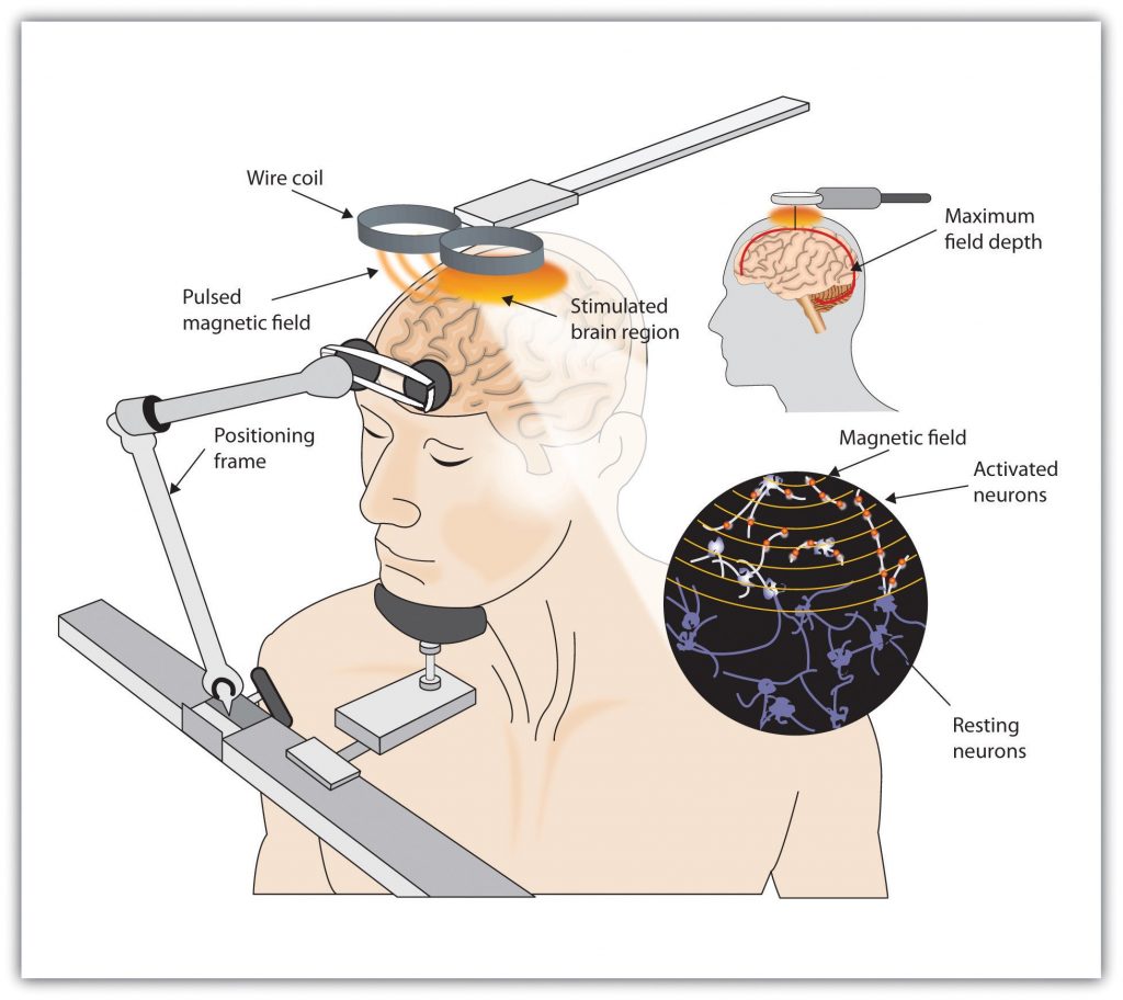 This image shows a drawing of an adult receiving TMS treatment. The person has its eyes closed and mouth shut, and is pressing their head against the positioning frame. There are wire coils placed above the person’s head, showing the stimulated brain region and pulsed magnetic field. Above the left shoulder of the figure there is a black circle with purple, white and red lines and shapes located inside. The purple lines and shapes are labeled “Resting neuron,” the white and red lines and shapes are labeled “Activated neurons,” and the horizontal red lines are labeled “Magnetic field.” To the back of the image there is a profile view of a human head, with a drawing of the brain inside. The wire coils are located above this head as well, similar to the larger photo. There is an arrow pointing towards the outside of the cortex labeled “Maximum field depth.”